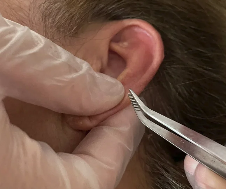 Aplicação de auriculoterapia na orelha